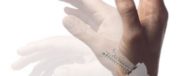 Handgelenksprothese - Neue Chancen bei Rheuma und Arthrose