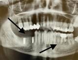 , Dr. med. Dr. med. dent. Hakan Tastan, Mund-Kiefer-Gesichtschirurgie impadia, Praxis für Mund-Kiefer-Gesichtschirurgie, Köln, Zahnarzt, MKG-Chirurg, Oralchirurg